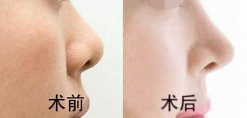 <a href=http://www.sbs17.com/listinfo-737-0.html target=_blank class=infotextkey>隆鼻</a>多久鼻頭可以消腫