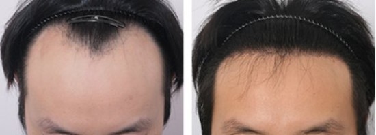發(fā)際線做了有副作用嗎