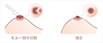 什么醫(yī)院有乳頭縮小術(shù)