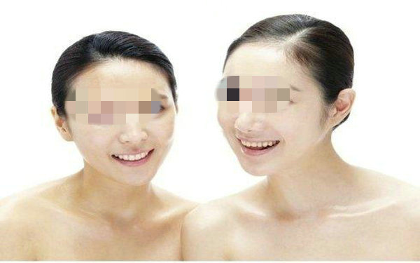 假體<a href=http://www.sbs17.com/listinfo-737-0.html target=_blank class=infotextkey>隆鼻</a>多久能恢復