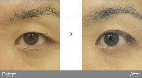 <a href=http://www.sbs17.com/listinfo-724-0.html target=_blank class=infotextkey>雙眼皮</a>紫色淤青怎么消