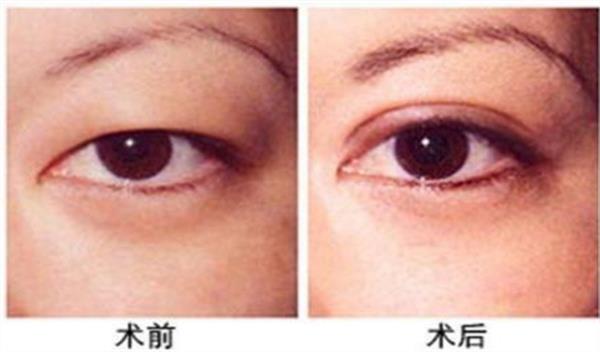 <a href=http://www.sbs17.com/listinfo-724-0.html target=_blank class=infotextkey>雙眼皮</a><a href=http://www.sbs17.com/listinfo-685-0.html target=_blank class=infotextkey>吸脂</a>恢復過程圖效果對比