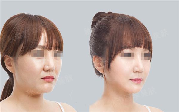 打完<a href=http://www.sbs17.com/listinfo-631-0.html target=_blank class=infotextkey>瘦臉</a><a href=http://www.sbs17.com/listinfo-614-0.html target=_blank class=infotextkey>除皺</a>多久吃飯