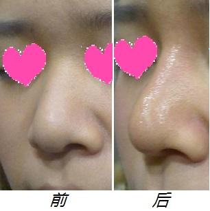 假體<a href=http://www.sbs17.com/listinfo-737-0.html target=_blank class=infotextkey>隆鼻</a>恢復過程案例
