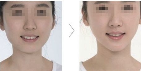 <a href=http://www.sbs17.com/listinfo-631-0.html target=_blank class=infotextkey>瘦臉</a>有哪些方法