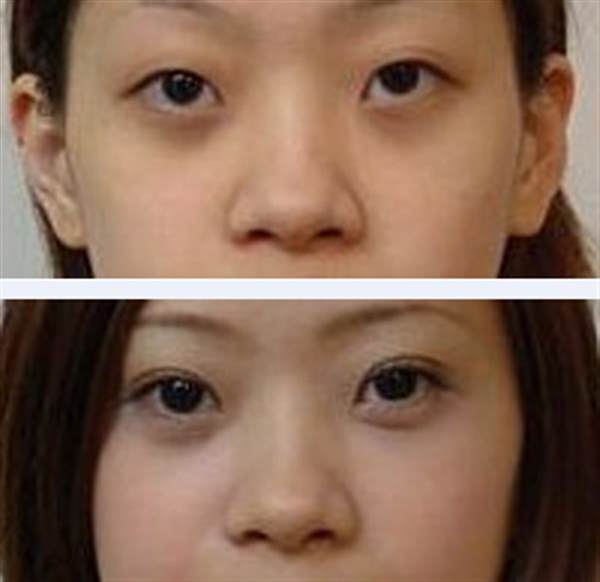 割<a href=http://www.sbs17.com/listinfo-724-0.html target=_blank class=infotextkey>雙眼皮</a>有疤怎么辦