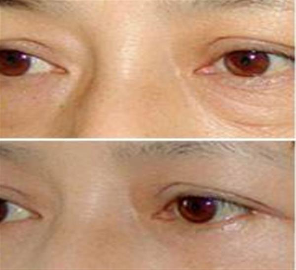 眼袋大了該怎么進行治療較好