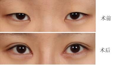 韓美<a href=http://www.sbs17.com/listinfo-724-0.html target=_blank class=infotextkey>雙眼皮</a>多少錢
