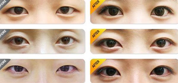 <a href=http://www.sbs17.com/listinfo-724-0.html target=_blank class=infotextkey>雙眼皮</a>埋線恢復(fù)過程圖效果對比