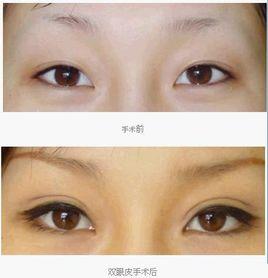 三點(diǎn)定位是可以拆掉的