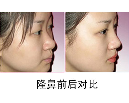 注射<a href=http://www.sbs17.com/listinfo-737-0.html target=_blank class=infotextkey>隆鼻</a>術(shù)手術(shù)風(fēng)險(xiǎn)