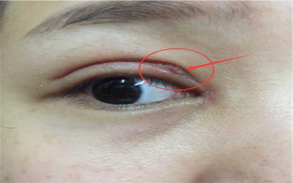 <a href=http://www.sbs17.com/listinfo-724-0.html target=_blank class=infotextkey>雙眼皮</a>增生怎么好得快