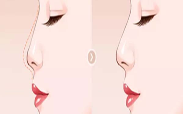硅膠假體<a href=http://www.sbs17.com/listinfo-737-0.html target=_blank class=infotextkey>隆鼻</a>后鼻子會(huì)透光嗎