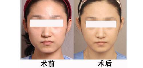 學(xué)生<a href=http://www.sbs17.com/listinfo-631-0.html target=_blank class=infotextkey>瘦臉</a>的較好方法