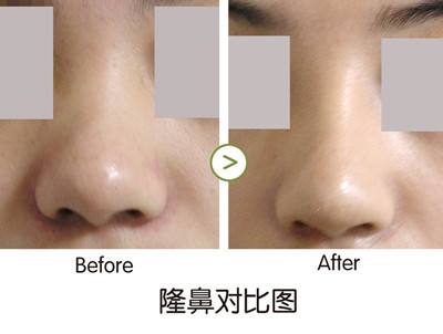 透明質酸<a href=http://www.sbs17.com/listinfo-737-0.html target=_blank class=infotextkey>隆鼻</a>需要費用