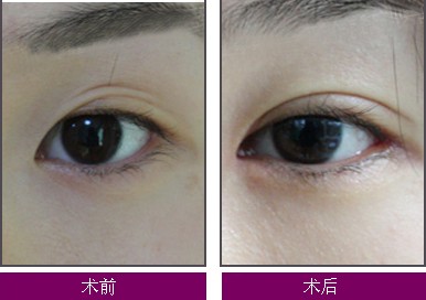 <a href=http://www.sbs17.com/listinfo-724-0.html target=_blank class=infotextkey>雙眼皮</a>埋線要費用大致是多少