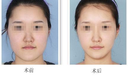 天津注射<a href=http://www.sbs17.com/listinfo-631-0.html target=_blank class=infotextkey>瘦臉</a><a href=http://www.sbs17.com/listinfo-614-0.html target=_blank class=infotextkey>除皺</a>價格