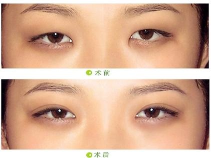 <a href=http://www.sbs17.com/listinfo-711-0.html target=_blank class=infotextkey>開(kāi)眼角</a>疤痕增生3個(gè)月恢復(fù)圖片