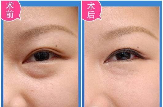 眼袋手術(shù)費(fèi)用多少