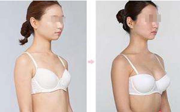 <a href=http://www.sbs17.com/listinfo-618-0.html target=_blank class=infotextkey>隆胸</a>后懷孕漲奶怎么辦